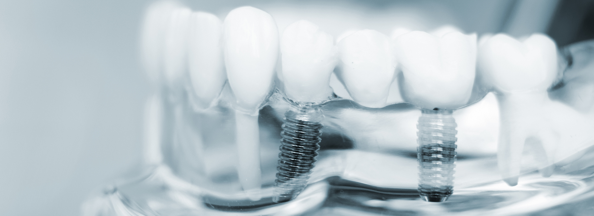 Dental Implantd Simi Valley