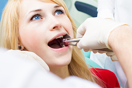 Dental Extractions Simi Valley