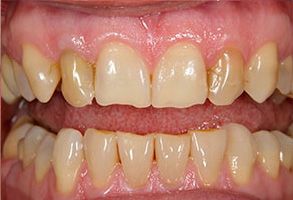 Royal Family Dental | Dental Bridges, Extractions and Dentures